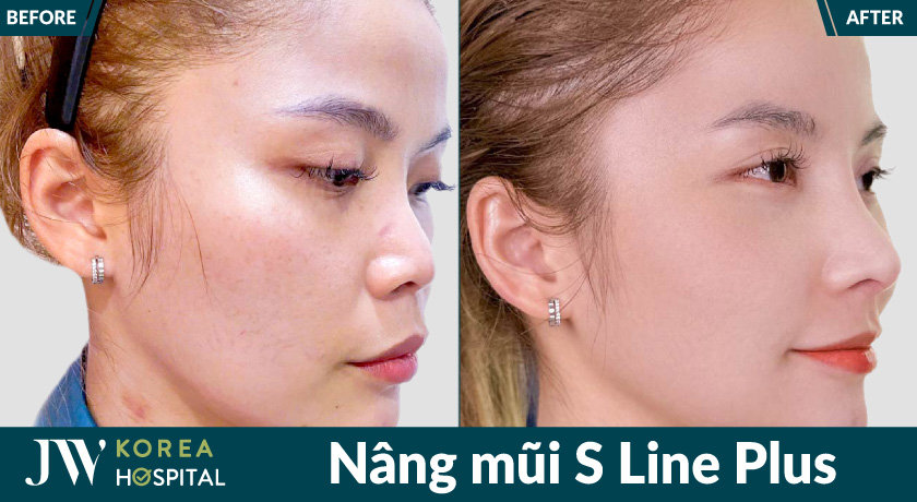 Kết quả nâng mũi S Line Plus tại JW giúp sở hữu dáng mũi cao cuốn hút, chuẩn tỉ lệ vàng