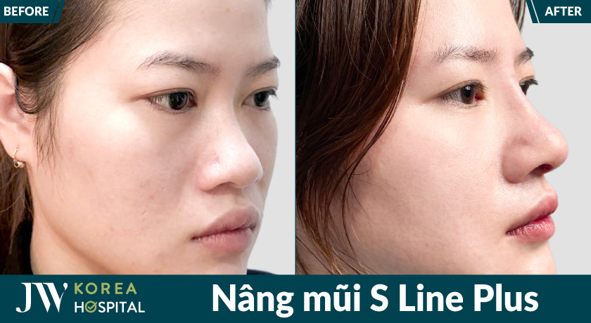 Hình ảnh trước sau nâng mũi S Line Plus của khách hàng tại JW 
