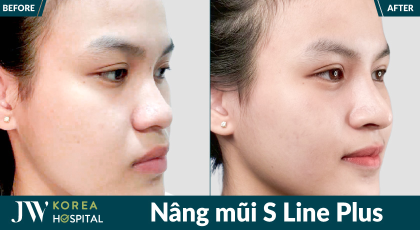 Nâng mũi S Line Plus tại Bệnh viện JW giúp sở hữu dáng mũi tự nhiên, cuốn hút 