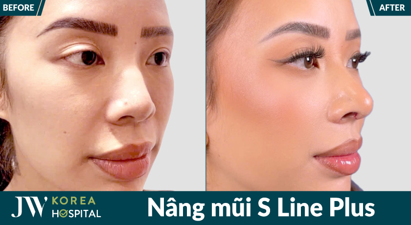 Nâng mũi S Line Plus tại Bệnh viện JW với sống mũi cao thanh thoát, cuốn hút 