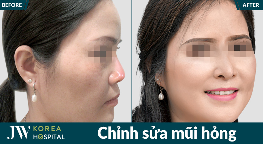 Tái phẫu thuật mũi hỏng lấy lại dáng mũi tự nhiên tại JW