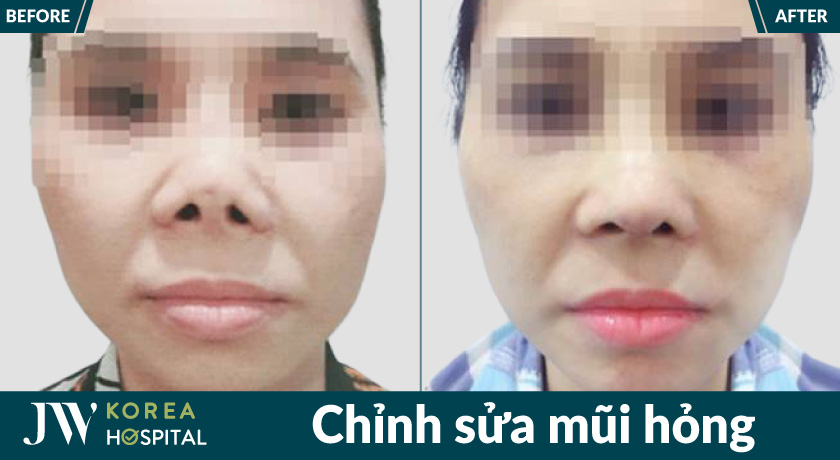 Chỉnh sửa mũi hỏng tại Bệnh viện JW giúp lấy lại dáng mũi cân đối, tự nhiên 