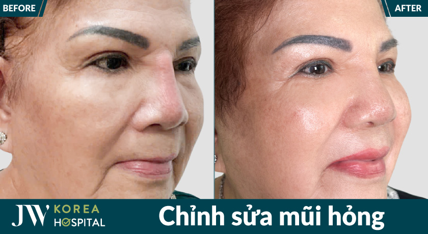Khắc phục mũi lệch, mũi biến chứng hậu phẫu thuật sau quá trình chỉnh sửa mũi hỏng tại Bệnh viện JW 