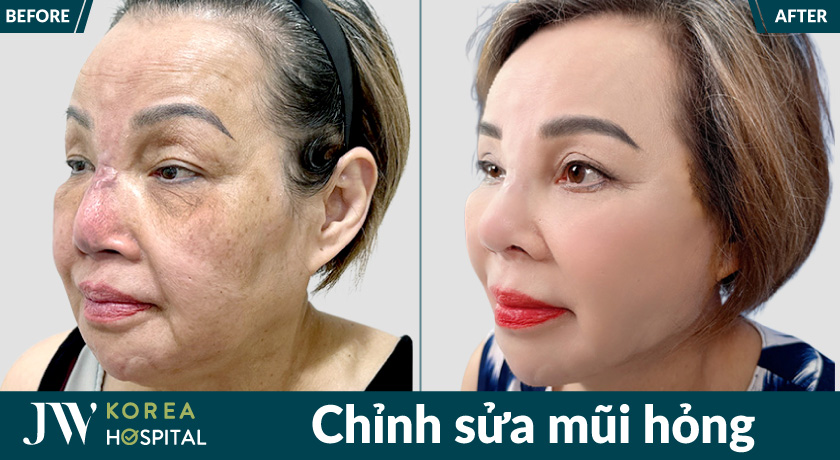 Tái tạo lại mũi tự nhiên sau quá trình chỉnh sửa mũi hỏng tại Bệnh viện JW