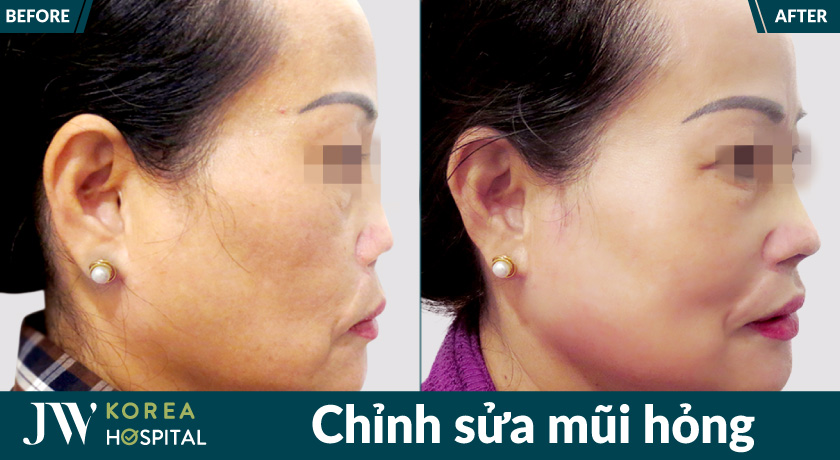 Hình ảnh trước và sau của khách hàng sau quá trình chỉnh sửa mũi hỏng tại bệnh viện JW 