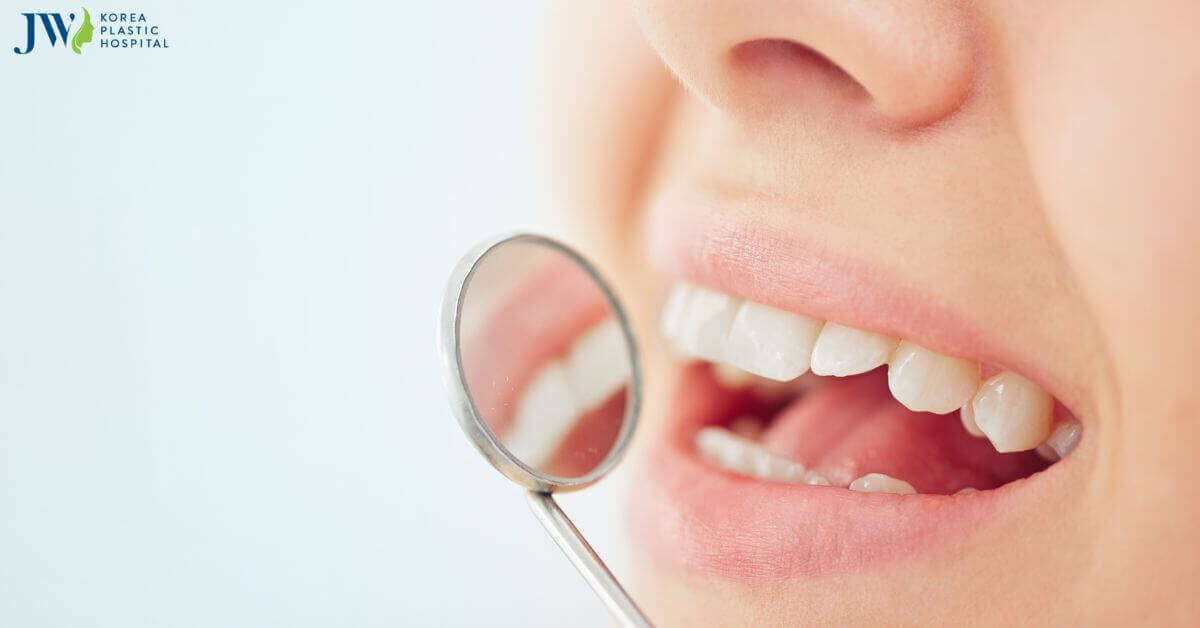 Dán Sứ Veneer không mài răng – Giải pháp bảo vệ răng hoàn hảo.