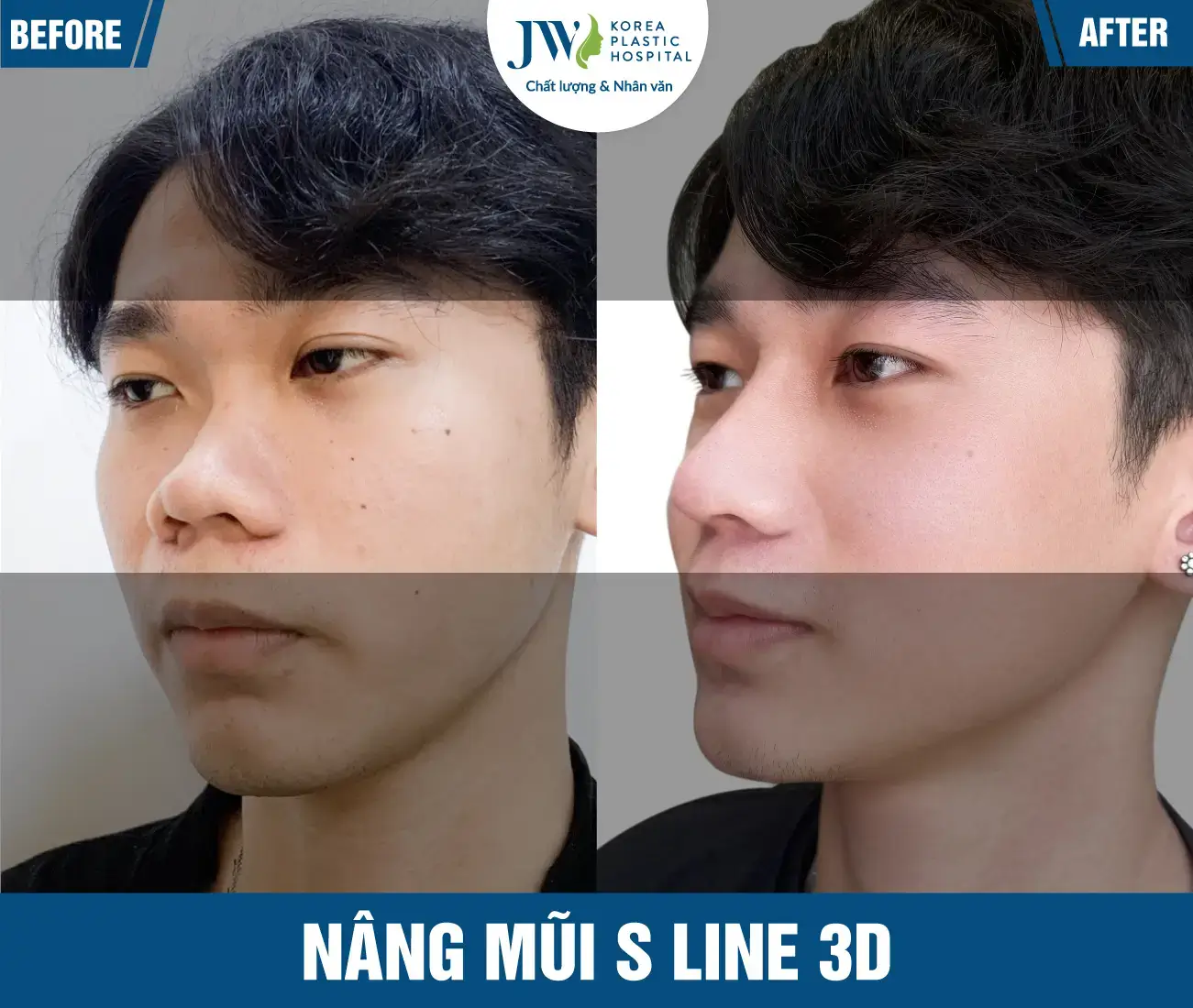 dv-nang-mui-s-line-3d-02-two