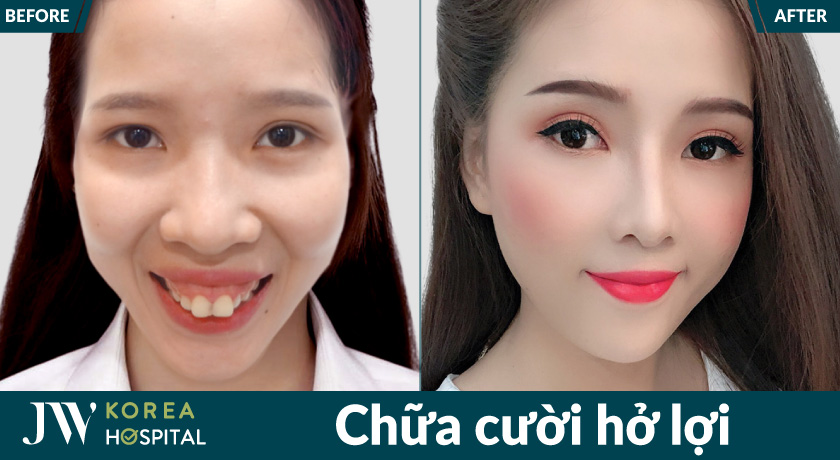 Điều trị cười hở lợi giúp giảm lộ nướu, tạo nụ cười tự nhiên và dễ nhìn hơn