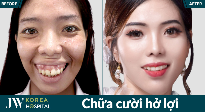 Chữa cười hở lợi giúp nụ cười cân đối, tự tin hơn