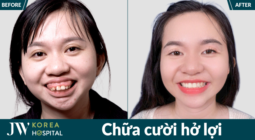 Chữa cười hở lợi giúp cải thiện đường cười, mang lại biểu cảm nhẹ nhàng hơn