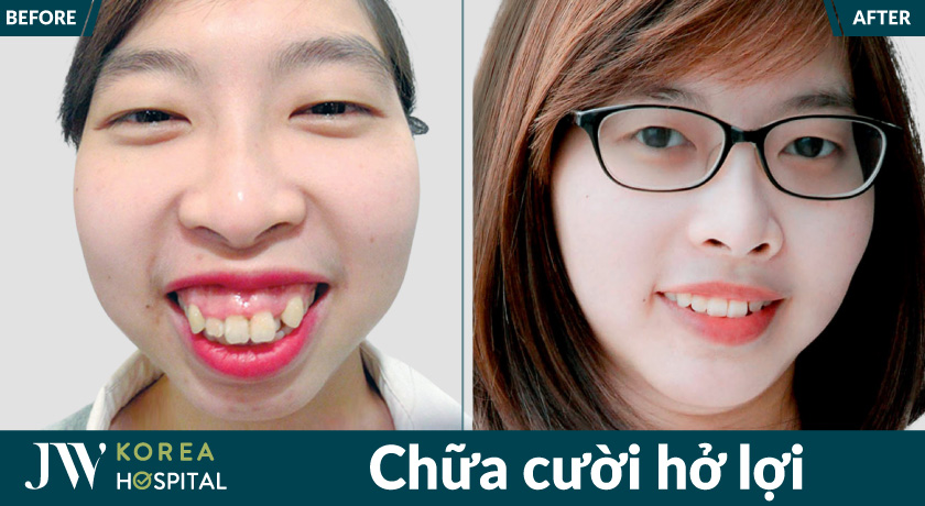 Hình ảnh khách hàng trước và sau chữa cười hở lợi tại bệnh viện JW
