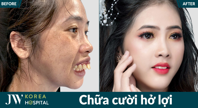 Khách hàng sau điều trị cười hở lợi sở hữu nụ cười cân đối và hài hòa hơn
