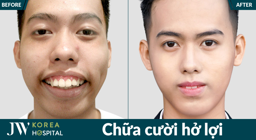 Kết quả sau điều trị giúp giảm hở nướu, tăng sự tự tin khi mỉm cười