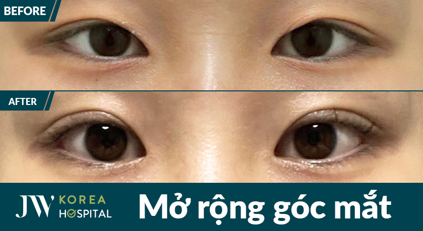Hình ảnh trước và sau của khách hàng khi mở rộng góc mắt tại Bệnh viện JW