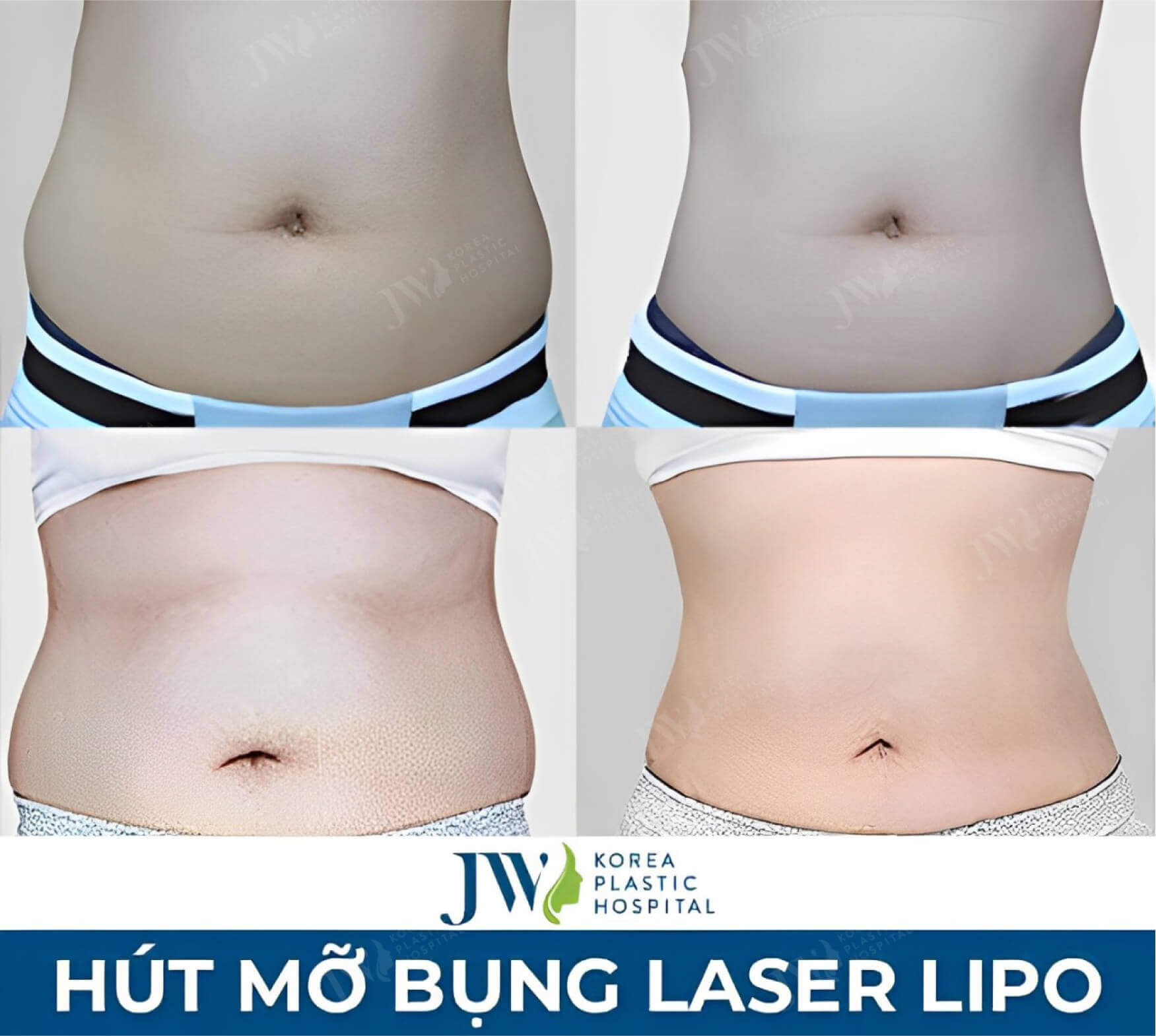 hut mo laser lipo jw