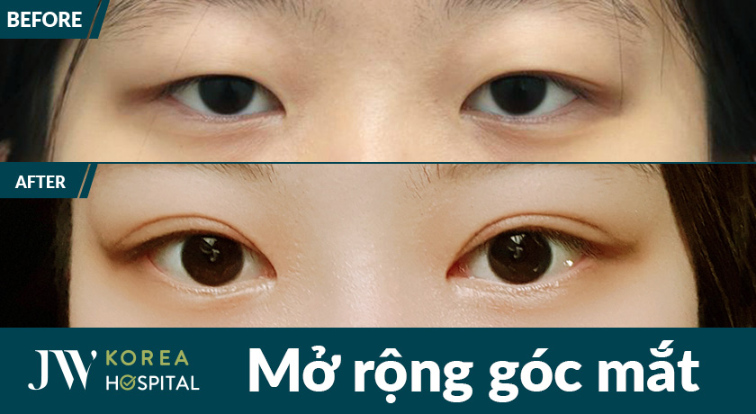 Kết quả thay đổi ngoạn mục, mắt to tròn long lanh sau thẩm mỹ mắt to tại JW