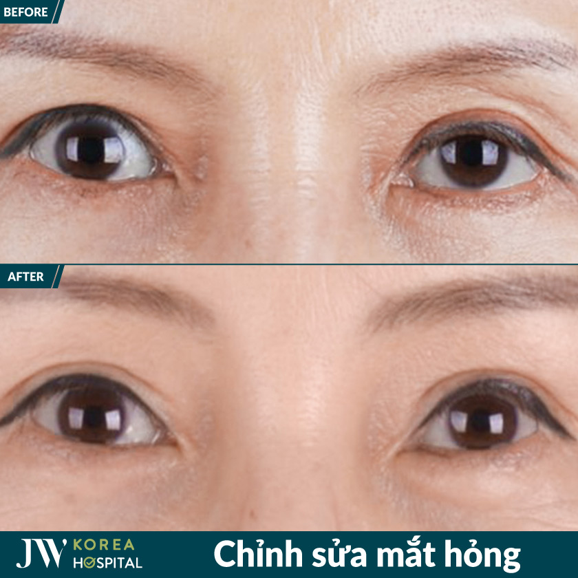 Loại bỏ biến chứng sau phẫu thuật lỗi, lấy lại ánh nhìn tự tin tại Bệnh viện JW