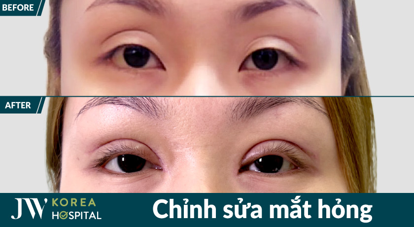 100% bác sĩ chuyên khoa tạo hình thẩm mỹ có chứng chỉ hành nghề trực tiếp thăm khám và thực hiện tại bệnh viện JW