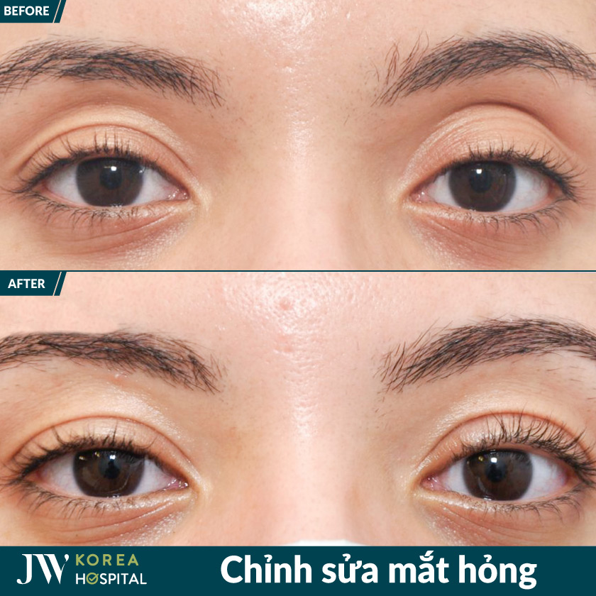 Lấy lại ánh nhìn tự nhiên sau 1 quá trình chỉnh sửa mắt hỏng tại Bệnh viện JW