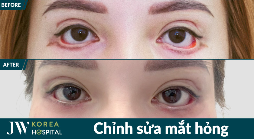 Khắc phục tình trạng lật mí mắt, mát sụp sau phẫu thuật lỗi với chỉnh mắt hỏng tại bệnh viện JW