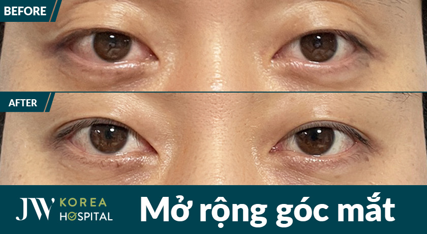 Kết quả trước và sau mở rộng góc mắt tại Bệnh viện JW