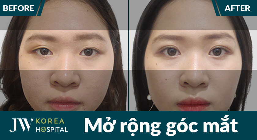 Khách hàng hài lòng tuyệt đối với kết quả sau khi thẩm mỹ mắt to tại JW