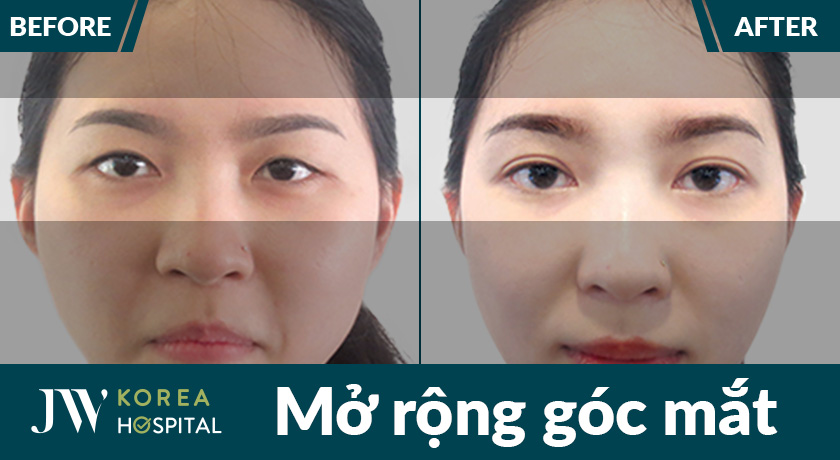 Lợi ích sau khi thẩm mỹ mắt to tại Bệnh viện JW được khách hàng đánh giá cao