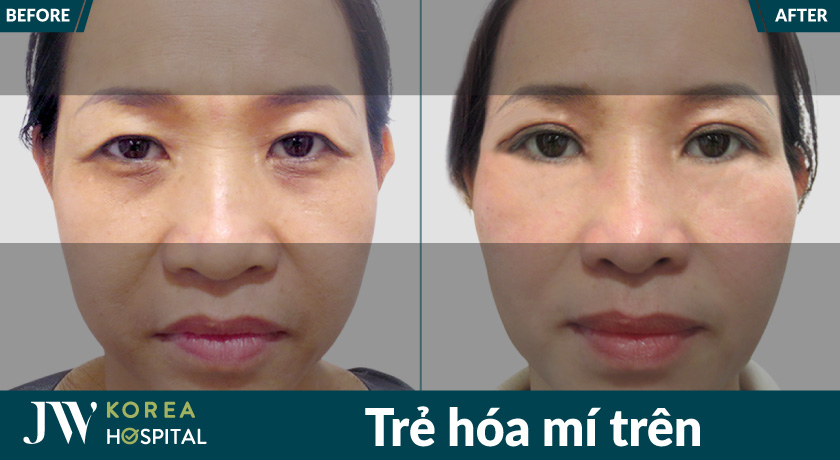 Xóa bỏ da dư, mỡ thừa, khắc phục tình trạng mí sụp hiệu quả với trẻ hóa mí trên tại Bệnh viện JW