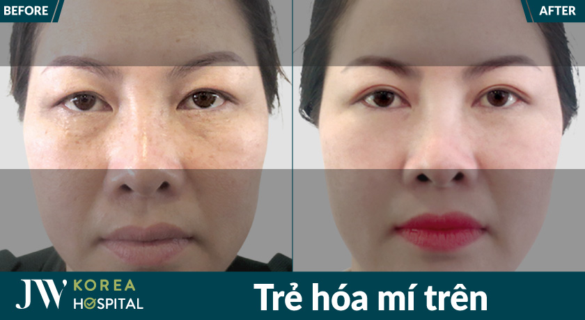 Mắt to, 2 mí rõ nét, không còn mí sụp với trẻ hóa mí trên tại Bệnh viện JW