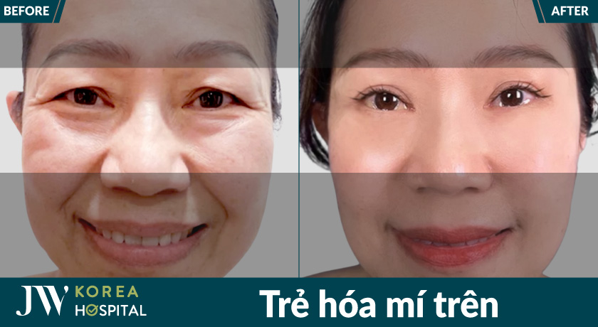 Trẻ hóa mí trên tại Bệnh viện JW giúp cải thiện tình trạng mí sụp, lấy lại ánh nhìn tươi trẻ