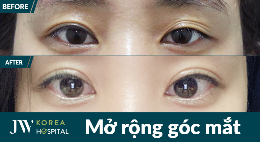 Mắt to tròn long lanh, 2 mí rõ nét sau thẩm mỹ mắt to tại Bệnh viện JW