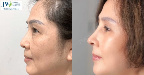 Nâng mũi khi về già: Những rủi ro nguy hiểm và cách phòng tránh