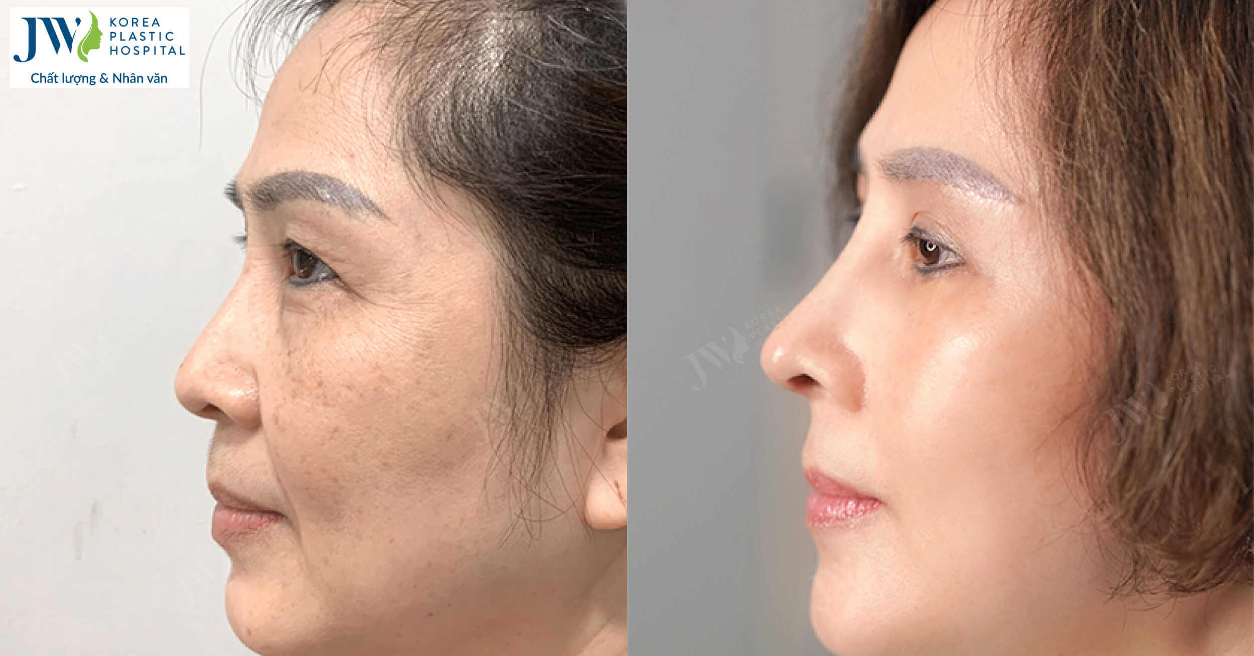 Nâng mũi khi về già: Những rủi ro nguy hiểm và cách phòng tránh