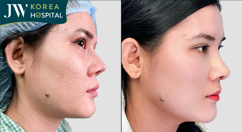 JW sửa mũi hỏng đẹp mềm mại