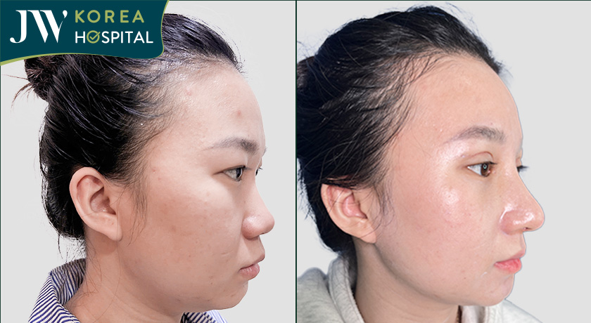 Nâng mũi cao quý phái cho Gen Z tại JW