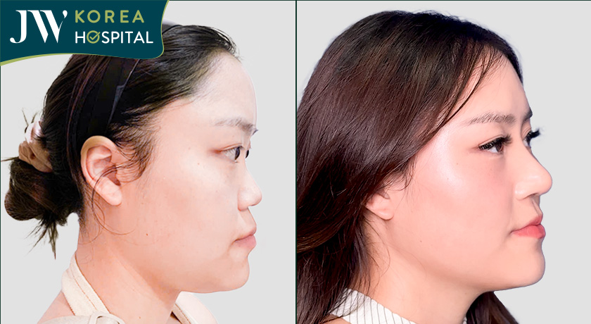 Dáng mũi S Line cao sang tại JW