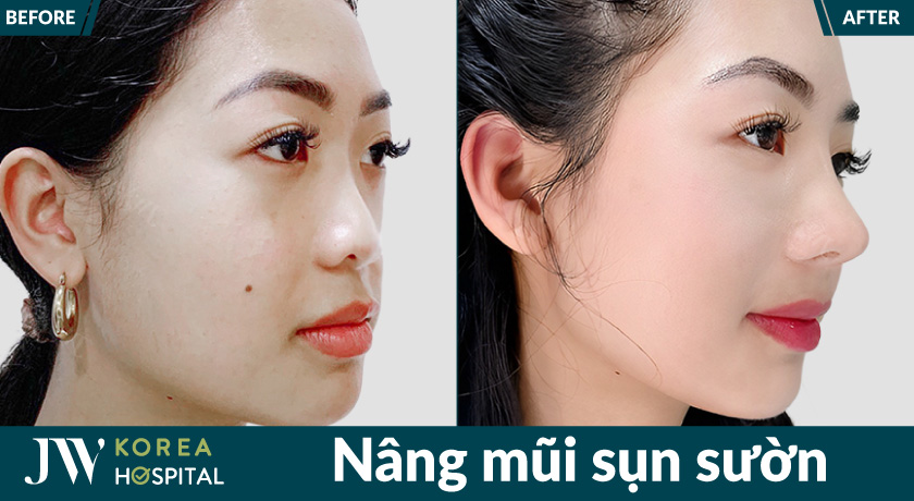 Kết quả của nâng mũi sụn sườn của Bệnh viện JW giúp khắc phục dáng mũi thấp, đầu mũi to 