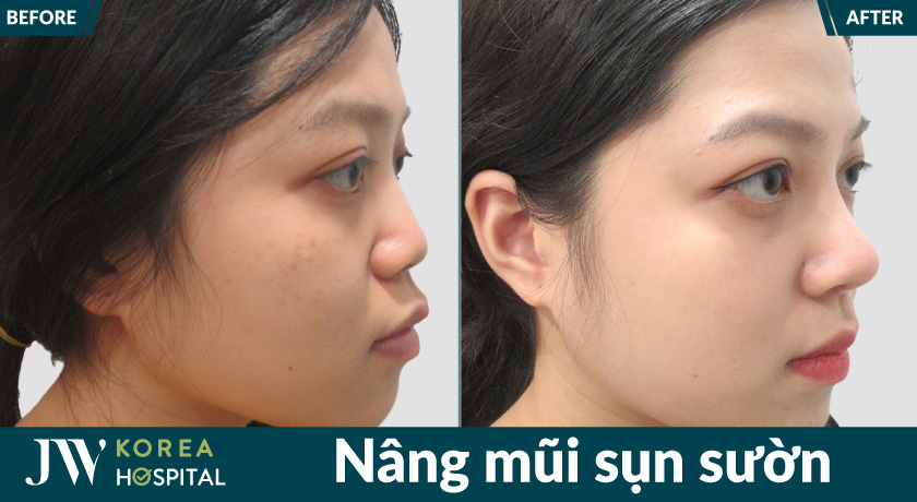 Sở hữu dáng mũi cao tự nhiên sau Nâng mũi sụn sườn tại Bệnh viện JW