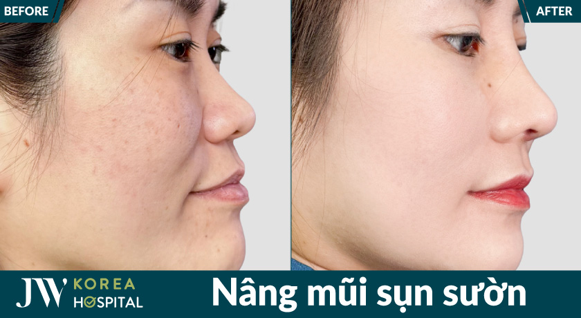 Bệnh viện JW nâng mũi sụn sườn giúp sở hữu dáng mũi cao tự nhiên, đẹp cuốn hút 