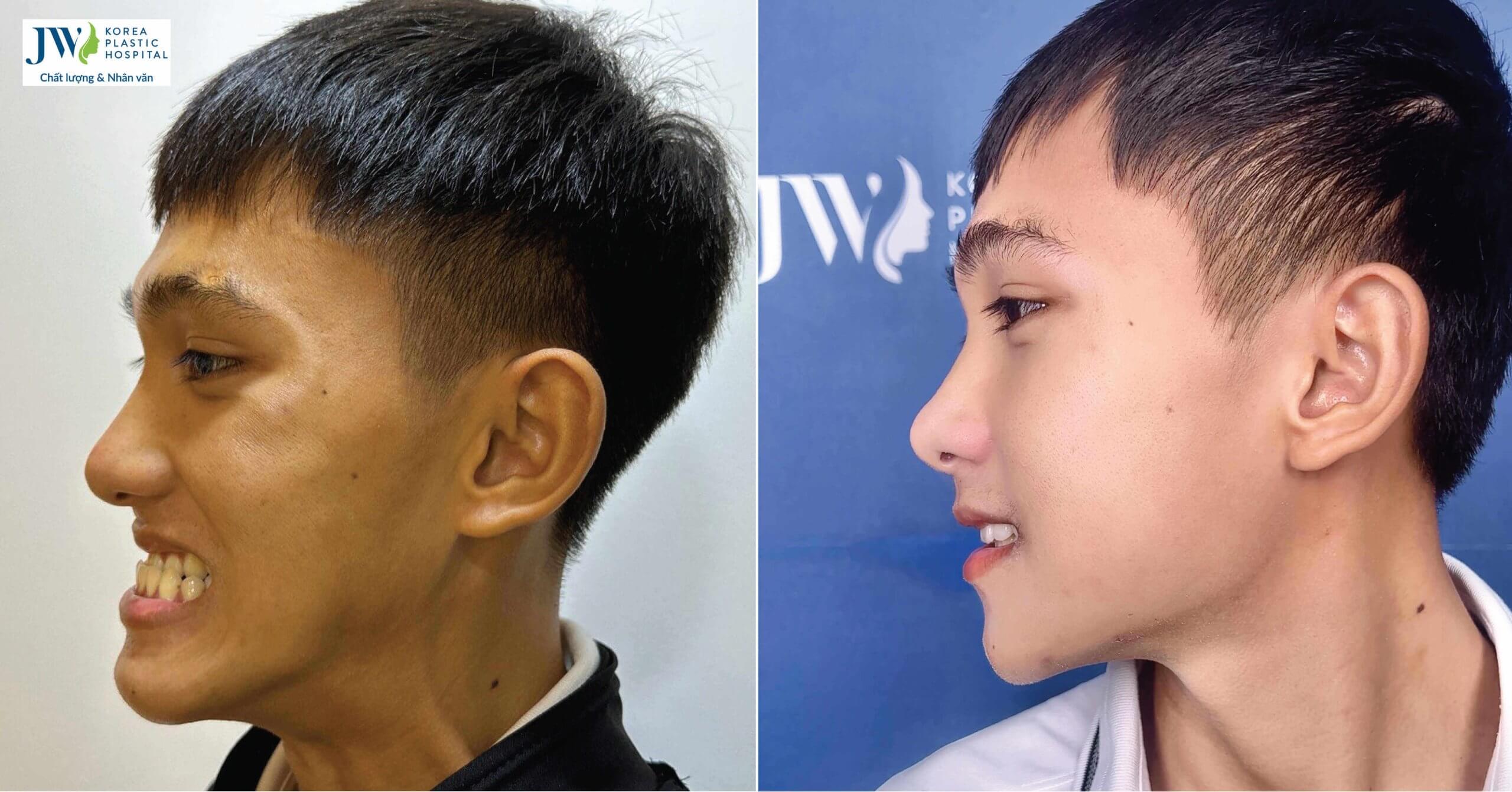 Phẫu thuật hàm móm giúp chàng trai GenZ trở thành Hot Boy vạn người mê