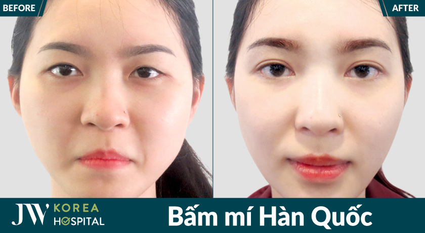Bấm mí Hàn Quốc mang lại đôi mắt cuốn hút tại Bệnh viện JW