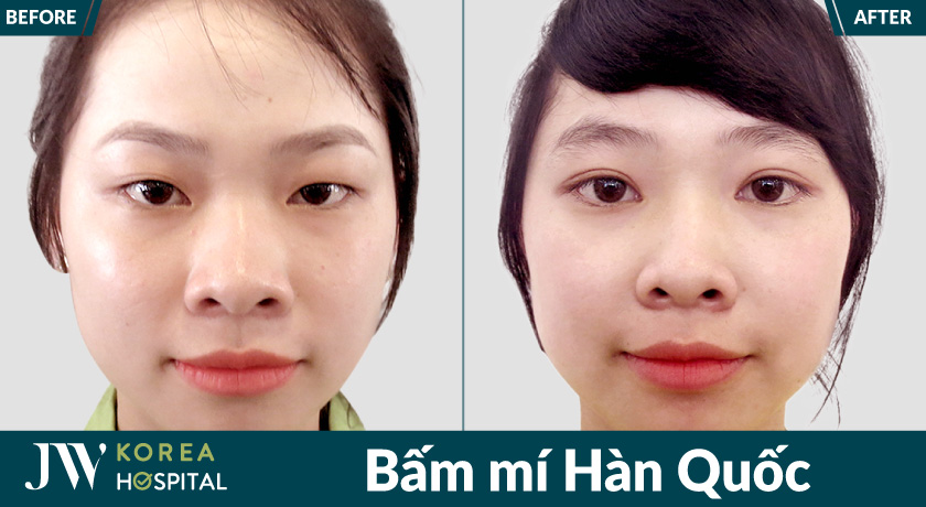 Bấm mí Hàn Quốc tại Bệnh viện JW tạo nếp mí tự nhiên, ánh nhìn tươi trẻ