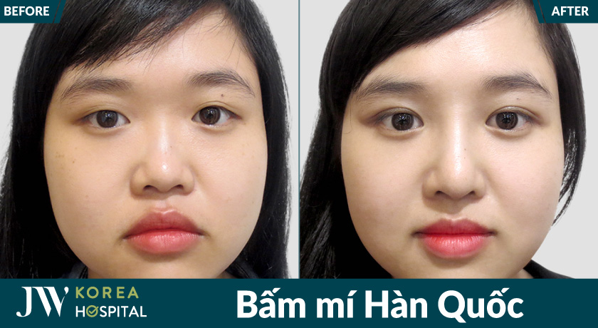 Bấm mí Hàn Quốc tại Bệnh viện JW giúp sở hữu mắt 2 mí rõ nét, cuốn hút 