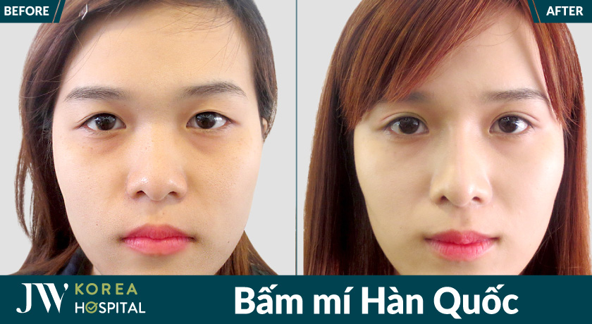 Mắt to tròn, long lanh sau bấm mí Hàn Quốc tại Bệnh viện JW