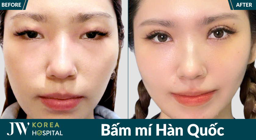 Quy trình thực hiện dịch vụ bấm mí Hàn Quốc tại Bệnh viện JW được thực hiện trong môi trường vô trùng, an toàn, đạt chuẩn y khoa
