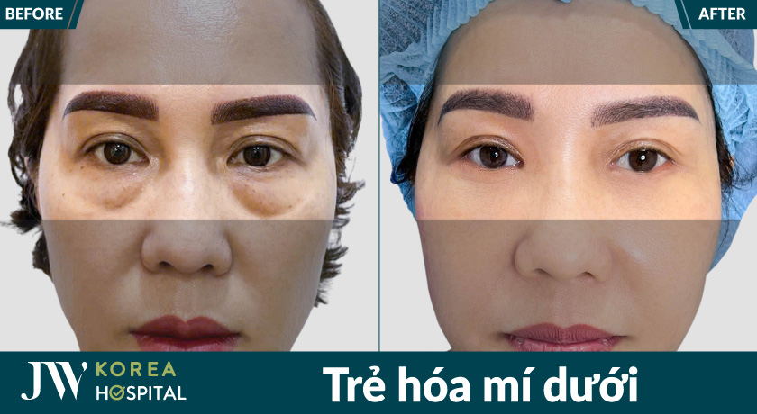 Dịch vụ trẻ hóa mí dưới tại Bệnh viện JW giúp xóa bọng mỡ mắt, mang lại ánh nhìn trẻ trung