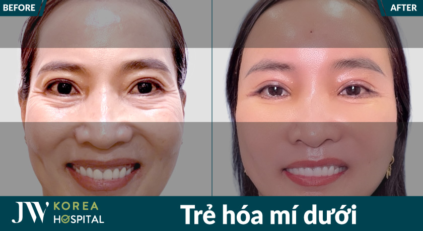 Trẻ hóa mí dưới cải thiện quầng thâm và bọng mắt hiệu quả tại bệnh viện JW