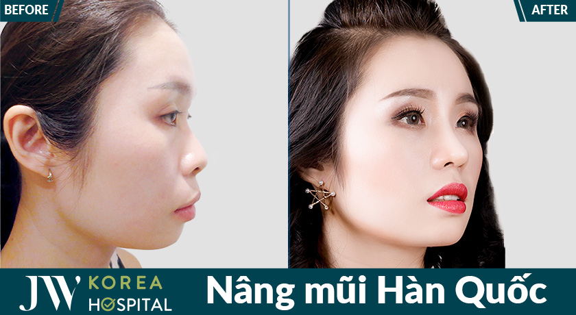 7 ngày sở hữu mũi cao sang sau Nâng mũi Hàn Quốc tại JW