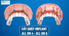 cay-ghep-implant-all-on-4-all-on-6-120x628px