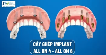 Cấy ghép implant All on 4 – All on 6 bí quyết lấy lại toàn hàm răng đã mất